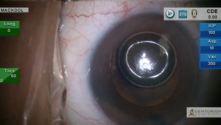 Fundamentals Episode 12: The Dense PSC Cataract with Posterior Capsule ...